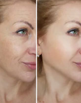 Botox BH - Botox Antes e Depois - Botox Contra Rugas Injecao Botox Marcas de Expressao Anti-Aging e Anti-Envelhecimento - Rejuvenescimento
